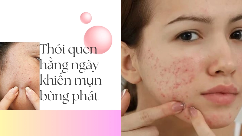 Thói quen chạm tay lên mặt làm tăng nguy cơ mụn viêm