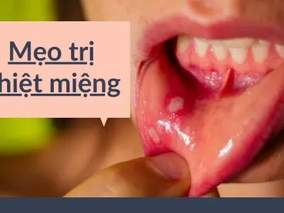 Mẹo trị nhiệt miệng hiệu quả giúp ăn uống không đau